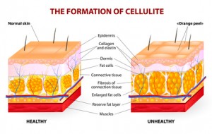 The formation of cellulite. Vector diagram